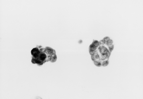 Figure 1.  Steroid sulfatase detection in MCF-7 cells by immunohistochemistry with anti-steroid sulfatase antibody. (×400).