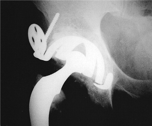 Figure 2 B. The same patient taken 4 years after revision surgery. The inferior hook fracture had been present for 3 years.