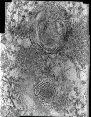 Figure 2. Electron microscopic view of myeloid bodies and mitochondrial swelling in proximal tubule epithelial cell in AK group.