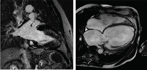 Figure 3. Hypertrophic versus dilated cardiomyopathy.Left: two-chamber delayed gadolinium enhancement imaging showing apical hypertrophic cardiomyopathy with diffuse mid-wall fibrosis in the hypertrophied segments. Right: Four-chamber SSFP imaging showing the typical appearance of dilated cardiomyopathy-related ventricular thinning.