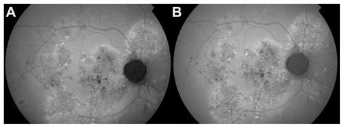 Figure 3 (A) Fundus autofluorescence of the case presented in Figure 1, showing widespread and multiple areas of retinal pigment epithelium atrophies at baseline. (B) Twelve months after the photodynamic therapy treatment, no significant worsening of the atrophies is observed.
