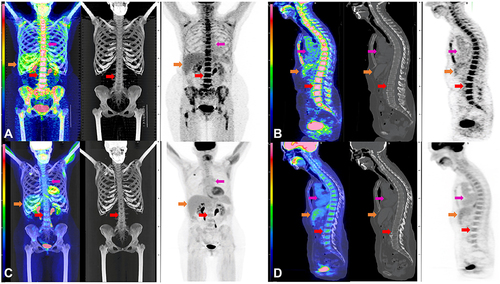 Figure 2 Initial FDG PET-CT and Post-Treatment FDG PET-CT for Case #1. Composite FDG PET-CT images of case #1 at initial diagnosis (A and B) and after R-CHOP and high-dose MTX (C and D). Coronal view of fused FDG PET-CT MIP, CT, and PET (A) and sagittal fused FDG PET-CT, CT, and PET (B) demonstrates intense FDG accumulation in the bone marrow of the axial and appendicular skeleton at initial diagnosis without a specific focus of FDG accumulation, nor lytic or sclerotic lesions on CT. Reference L3 vertebral body SUVmax of 9.9 (red arrow). Physiologic FDG accumulation is seen in the liver (Orange arrow) and blood pool (magenta arrow) and spleen. No hypermetabolic lymph nodes or other soft tissue to suggest lymphomatous involvement. Post treatment fused FDG PET-CT MIP, CT, and PET (C) and sagittal fused FDG PET-CT, CT, and PET (D) demonstrate normalization of FDG accumulation in the bone marrow of the axial and appendicular skeleton (red arrow) with the L3 vertebrae (SUVmax of 2.3), and unchanged FDG accumulation in the liver (Orange arrow) and blood pool (magenta arrow).
