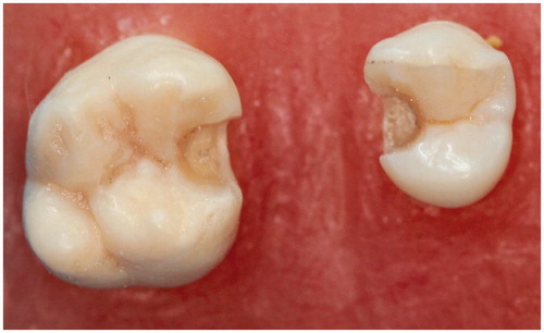 Figure 1. Preparation of the inlay cavities on premolar and molar.