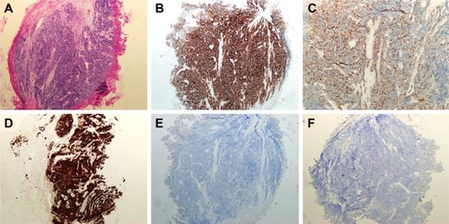 Figure 3 Hematoxylin–eosin staining and immunohistochemistry in small-cell cancer after crizotinib treatment.