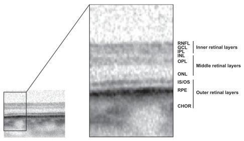 Figure 2 SD-OCT scan through nonischemic extrafoveal retina with different hyper-reflective bands representing the anatomical retinal layers of the retina.