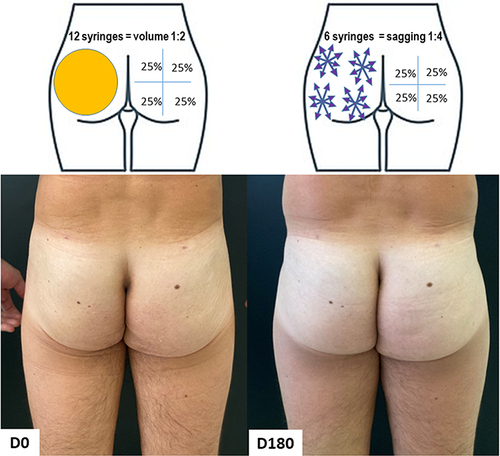 Figure 11 Case 6, Buttocks Beautification 3D. Schematic representation of the injections (above). Standardized posterior images pre and 180 days post injection (below). Each syringe = 1.5 mL of CaHA.