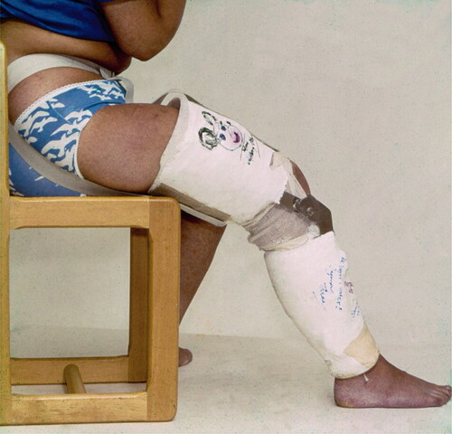 Figure 3. 4 to 5 weeks postoperatively, a partly mobile cast brace was applied that allowed 40° of flexion, from 20° to 60°. Courtesy Ejnar Eriksson, MD.