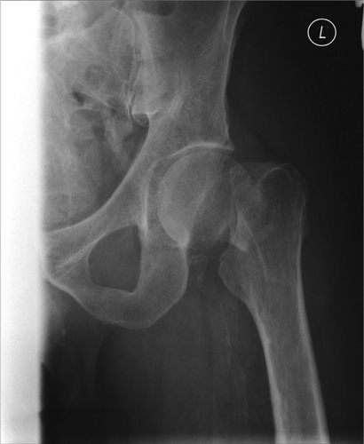 Figure 2 Displaced fracture neck of femur in an independently mobile 78 year old.