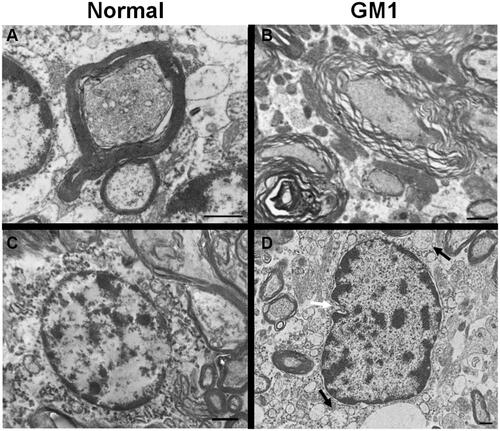 Figure 1 Transmission Electron Microscopy (TEM) images of feline CNS tissue. Normal axon in cross-section surrounded by thick myelin sheath (A). Multiple axons in cross-section of GM1 white matter, surrounded by disjointed and unravelling myelin layers (B). Normal oligodendrocyte with round nuclear envelope and prominent cytocavitary network (C). GM1 oligodendrocyte with multiple swollen mitochondria (black arrows) and irregularly-shaped nuclear envelope (white arrow) (D). Scale bars are 1μm. Transmission electron micrographs in panels A, B, and D, reproduced with permission Gray-Edwards HL, Maguire AS, Salibi N, et al. 7T MRI predictsamelioration of neurodegeneration in the brain after AAV genetherapy. Mol Ther - Methods Clin Dev. 2020;17:258–270.Citation146 © 2019 Elsevier.