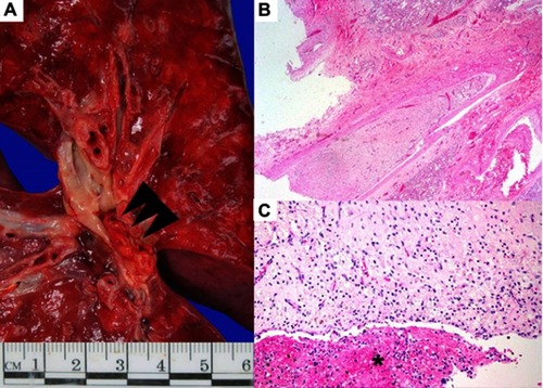 Figure 2 Left lung with pulmonary thromboembolus. (A) Fresh specimen. Red-white thrombus (arrowhead) in the descending branch of the left pulmonary artery. (B, C) Histopathological features of pulmonary thromboembolus showing organized (asterisk) and recanalized thrombus. Hematoxylin and eosin; original magnification, 20× in b and 100× in c.