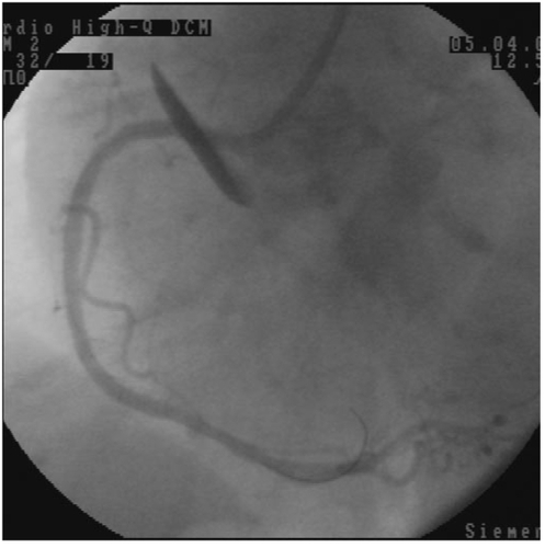 Figure 2 The right coronary arteriography after stenting and DeBakey type II (Stanford type A) dissection in the 60° left anterior oblique position.