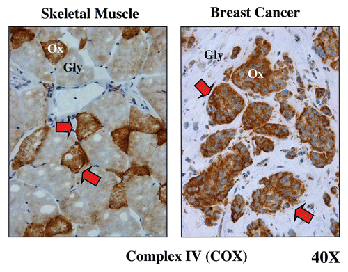 Figure 5 Metabolic compartmentalization of mitochondrial activity in skeletal muscle and human breast cancer. Frozen sections from skeletal muscle tissue or human breast cancers were subjected to a routine histochemical stain that detects the functional activity of mitochondrial complex IV [cytochrome C oxidase (COX)]. This allows the visualization of oxidative mitochondrial metabolism in tissue sections. COX-positive cells are positively stained brown (see red arrows). In skeletal muscle, note that fast-twitch fibers are glycolytic (Gly) and are COX-negative, while slow-twitch fibers are oxidative (Ox) and are COX-positive. In breast cancers, the tumor stroma is glycolytic (Gly) and is COX-negative, while epithelial tumor cell nests are oxidative (Ox) and are COX-positive. These results support the idea that tumors show metabolic compartmentalization and specialization, as occurs in skeletal muscle tissue. Reproduced and modified with permission from reference Citation14.