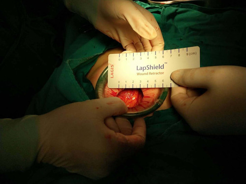 Figure 2 A trans-umbilical skin incision of a transversal length of 3 cm was made.