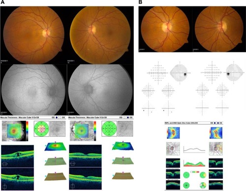 Figure 1 Representative images and test results for a patient with macular hole in the right eye and normal left eye are shown. (A) Optic nerve photographs, automated visual field test results, and SD-OCT of the optic nerve. (B) Fundus photographs, fundus autofluorescence, and SD-OCT of the macula