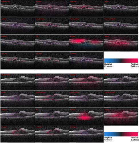Figure 1 Heatmaps for scans with the larger pathologies – (top) choroidal neovascularization (CNV) and (bottom) diabetic macular edema (DME). For each case - Row 1: Input image, DeConvNet, Deep Taylor, DeepLIFT. Row 2: Gradient, GBP, Input times gradient, IG. Row 3: LRP – EPS, LRP – Z, Occlusion, Salience. Row 1: Input image, DeConvNet, Deep Taylor, DeepLIFT. Row 2: Gradient, GBP, Input times gradient, IG. Row 3: LRP – EPS, LRP – Z, Occlusion, Salience. Row 4: SHAP Random, SHAP Selected, SmoothGrad. The scale in the bottom right shows that the parts highlighted in magenta color provide positive evidence regarding presence of a disease while those in blue color provide a negative evidence indicating that the image is closer to normal. DeepTaylor, GBP perform the best, SHAP highlights partial but precise regions. The fluid accumulation for CNV and the edges of the edema for DME were highlighted by better performing methods.