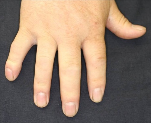Figure 1 Dactylitis of the second and third fingers.