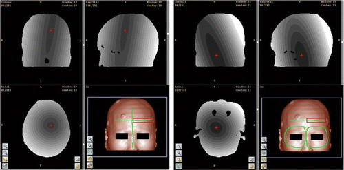 Figure 3. Spatial distribution of TRE in surface matching. The left set of images represent a case of registration with scanning area PClaser1. The right set of images represent a case of registration with scanning area PClaser2. In both cases, the upper left, upper right and lower left panels correspond to the coronal, sagittal and axial sections that pass through the center point, which is indicated by a small red cross. The lower right panel in each set is the 3D visualization of the head segmented out from the background by thresholding. On the section images, the TRE at the points where the CT value is larger than the threshold is mapped into a gray value, with dark gray indicating a smaller TRE and light gray indicating a larger TRE. The TRE in the area within the innermost iso-valued surface is 0.5 voxels in the left image and 1.6 voxels in the right image, and the TRE increases by 0.1 voxels with each iso-valued surface moving outward.