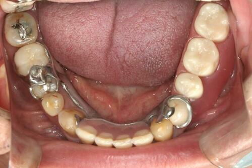 Figure 11 Lower denture in situ (flipped mirror image).