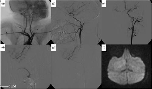 Figure 1. Angiographic analysis of the artery after modeling. (a) The left-common carotid artery and the right-brachiocephalic artery had a common stem and were open to the aortic arch (black arrow). Both sides of the vertebral artery were emitted by the subclavian artery (white arrow). (b) The internal carotid artery was thinner and longer than the external carotid artery, and the distal part of the internal carotid artery was divided into the ocular artery (white arrow) and the posterior communicating artery (black arrow). (c) After one side of the internal-carotid-artery angiography, the contralateral cerebral artery could be seen through the anterior communicating artery. (d) Angiography showing middle cerebral artery and branches before embolization. (e) Angiography showing a decrease in the middle-cerebral-artery branch after embolization. (f) DWI showing patchy high-signal area 2 h after embolization.