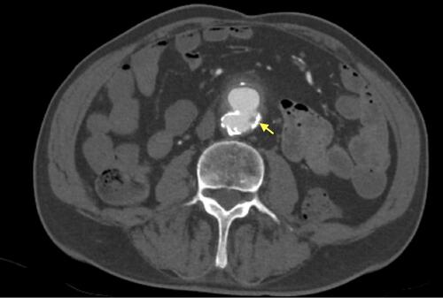 Figure 1 Axial image of CT angiogram on day 4 post-admission showing inflammatory stranding and wall thickening involving the proximal anastomosis of the aorto-bi-iliac graft and the posterior aspect of third part of the duodenum, small gas locules present within the wall of the aortic sac where it was crossed by the duodenum, indicated by yellow arrow.