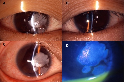 Figure 1 Findings in a patient with a white corneal plaque on the right eye at initial examination.