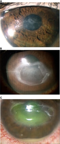 Figure 1 Stage 1 neurotrophic keratitis (A) showing cloudy and irregular corneal epithelium associated with mild stromal scarring. Stage 2 neurotrophic keratitis (B) with a large persistent epithelial defect characterized by smooth, rolled edges. No signs of ocular inflammation are present. Stage 3 neurotrophic keratitis (C) characterized by deep corneal ulcer, stromal melting, and sterile hypopyon.