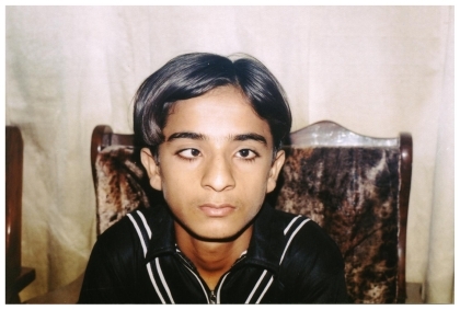 Figure 1 A 13-year-old boy with right eye concomitant strabismus.