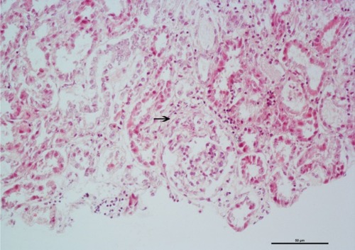 Figure 2 Renal biopsy specimen showing mild focal segmental extracapillary proliferation (arrow); hematoxylin and eosin stain.