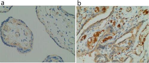 Figure 3. VEGF expression in placenta by immunohistochemistry (x 400); a: Control group (-); b: ISUA group (+++).