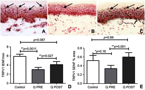 Figure 3 Immunohistochemistry in skin biopsies for TRPV1, before and after capsaicin 8% patch treatment. Intra-epidermal nerve fibers (arrowed) and sub-epidermal nerve fibers from (A) control subjects, at the baseline visit (B, Q PRE) and, after capsaicin 8% patch treatment (C, Q POST), magnification x40. (D) Bar chart of intra-epidermal nerve fibers for TRPV1 (IENF) counts; (E) bar chart of sub-epidermal (SENF) analysis (% area) for TRPV1.