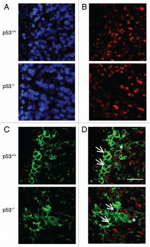 Figure 5 Detection of DNMT1 and hypoxic regions in HCT116 xenografts by immunofluorescence. Blue channel is nuclear staining by DAPI (A), red channel is DNMT1 (B), green is CA IX/hypoxia marker (C), and overlay of DNMT1 and CA IX (D). Arrows indicate cells which are hypoxic and DNMT1 negative. Asterisks indicate cells which are both hypoxic and expressing DNMT1. Scale bar represents 50 µm.