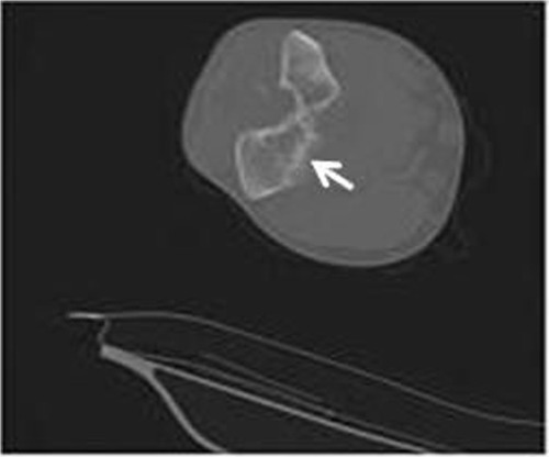 Figure 2 On CT scan, chondral erosions can be seen posterior to the elbow joint in axial sections with arrow.