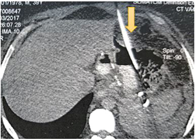 Figure 2. A coronal abdominal CT section showing the percutaneous radiological drainage (yellow arrow).