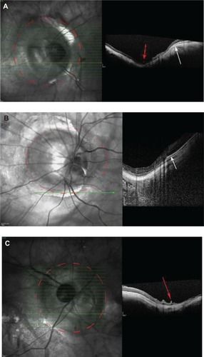 Figure 4 Postoperative optical coherence tomography images of (A) Case 7, (B) Case 4, and (C) Case 5 showing type 3 posterior staphyloma (outlined with dashed red line). Note retinal vascular folds (red arrows) and attenuated choroid and retinal pigment epithelium (white arrow).