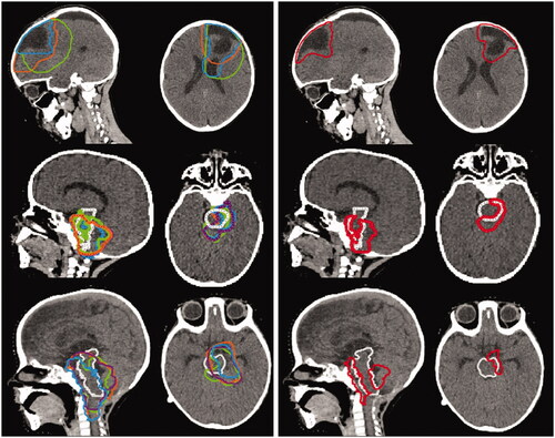 Figure 1. Illustration of the differences in CTV delineations (transversal/sagittal views) for the three cases (Case 1 upper row, Case 2 middle row, Case 3 lower row). The box to the left presents the independent delineations (Center C1 blue, Center C2 green, Center C3 orange, Center C4 purple) while the consensus CTV is presented in red in the box to the right. The brainstem is delineated in white. Note that for Case 1, only three paediatric radiation oncologists delineated the CTV.