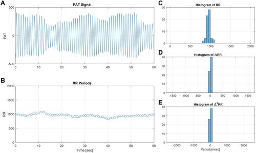 Figure 1 Normal sinus rhythm. The PAT signal (A) and the derived RR periods (B) in a window of 60 seconds, with histograms of the RR periods (C) and the first and second derivatives sequences (D and E), demonstrate the distribution of RR periods with typical heart rate variability.