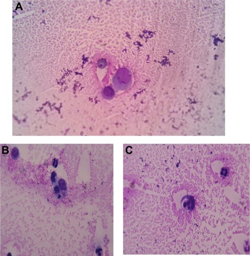 Figure 3 Wright stain images of a patient with rheumatoid arthritis.Notes: (A) Activated macrophage in synovial fluid of rheumatoid arthritis. wright stain, synovial fluid smear from a patient with rheumatoid arthritis 1,000×; (B) and (C) macrophages phagocytizing a small lymphocyte and neutrophil granulocytes. wright stain 1,000× (rheumatoid arthritis).