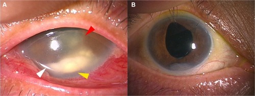 Figure 2 Anterior segment at recurrence and at the last visit.