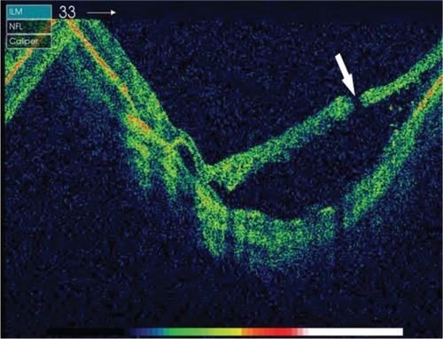 Figure 3 Preoperative optical coherence tomography image of Case 6 showing full-thickness juxtapapillary microhole (white arrow).