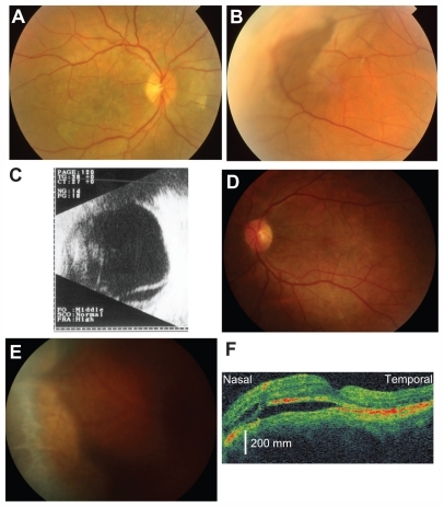 Figure 1 Photograph of the posterior pole (A) and peripheral region (B) of the right eye of a patient with idiopathic uveal effusion syndrome (IUES) in July 2001. A choroidal detachment can be seen (B). The ultrasonographic image of the right eye shows a retinal detachment in the inferior hemisphere (C). Photograph of the posterior pole (D) and peripheral region (E) of the left eye in September 2006. A ciliochoroidal detachment can be seen (E). Optical coherence tomography shows a macular detachment in the left eye (F).