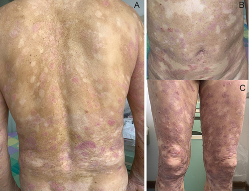 Figure 3 After 16-day treatment, the lesions of both psoriasis and BP largely subsided. Erythema, plaques, and blisters on the trunk have basically resolved (A and B). Dark erythema, plaques, and a few crusts are present on the legs (C).