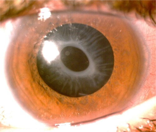 Figure 3 Slit lamp photograph showing anterior capsule opacification and phimosis after cataract surgery with in-the-bag IOL implantation.