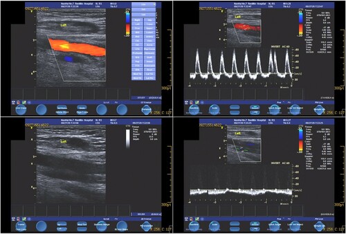 Figure 5. Colour Doppler ultrasound image: Deep vein blockage in left lower limb.