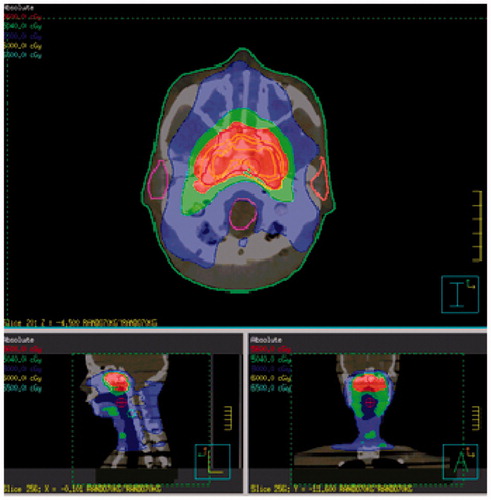 Figure 3. The NPC treatment plan for Pinnacle planning system of Philips Radiation Oncology System (Fitchburg, WI).