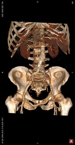 Figure 2 (A) CT 3D reconstruction image showing endovascular aortic stent-graft and right-to-left femoral-femoral crossover PTFE graft.