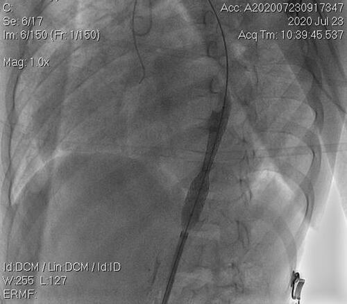 Figure 4 The first 12×59 mm cover stent at the distal of the descending thoracic aorta.