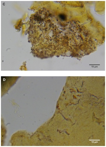 Figure 4 (A) Warthin–Starry-stained section of a Morgellons disease callus, patient 2, demonstrating a spirochete (arrow). 1000× magnification. (B) Dieterle stain, spirochete from patient 1 (arrow). 1000× magnification. (C) Dieterle stain, spirochetes from patient 2. 1000× magnification. (D) Dieterle stain, spirochetes from patient 3. 1000× magnification. (E) Dieterle stain, spirochetes from patient 4. 1000× magnification. (F) Warthin–Faulkner-stained bovine digital dermatitis section, showing numerous spirochetes among keratinocytes. 1000× magnification.