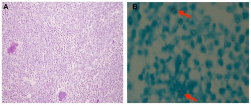 Figure 2 (A) hematoxylin and eosin stain showing necrotic tissue with neutrophilic infiltration (original magnification × 400). (B) Ziehl–Neelsen stain demonstrating acid-fast bacilli (original magnification × 400).