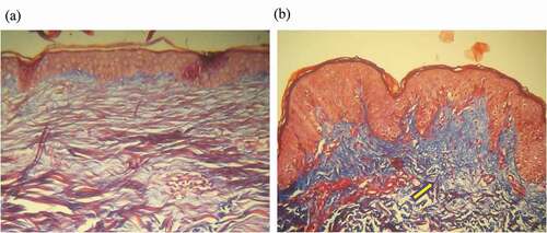 Figure 4. Histopathology of the percentage area of collagen (100x magnification) in the study subjects in the combination therapy group FMR + fractional CO2 laser, pre therapy (A) and post therapy (B). Yellow arrows indicate an increase in the amount of collagen