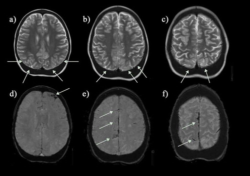 Figure 6. This teenager presented with sudden onset of blindness and seizures soon after acute chest syndrome. (a-c) There is occipital and frontal cortical and subcortical swelling on T2-weighted MRI, consistent with posterior reversible encephalopathy syndrome (green arrows) and (d-f) the susceptibility weighted imaging (SWI) revealed hemorrhage in the parafalcine and left frontal regions (green arrows). The magnetic resonance angiograms was normal. The patient returned to mainstream school but developed epilepsy